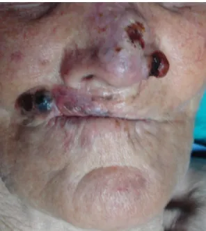 Figure  1:    Clinical  appearance  of  the  lesions  that  were  seen  on  the  left  ala  nasi and the right commisure of the lips