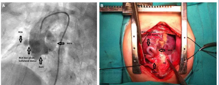 Figure 1.  (A) Angiogram demonstrating blood circulation of the main pulmonary artery provided by a tortuous collateral vessel  stemming from the right coronary artery