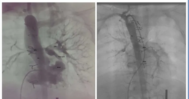 Figure 2.  (A) Catheter angiogram demonstrating inadequately developed pulmonary arterial bed for  complete  correction, and unifocalization surgeries, and two collateral arteries stemming from aorta