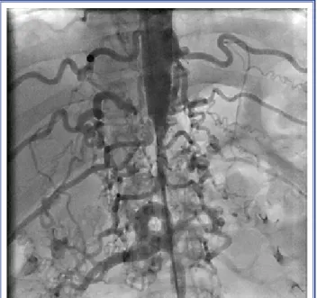Figure 1.  Catheter angiographic examination revealed dif- dif-fuse hypoplasia in the abdominal aorta, starting from level of  the diaphragm and extending to 2 cm above the iliac artery  bifurcation