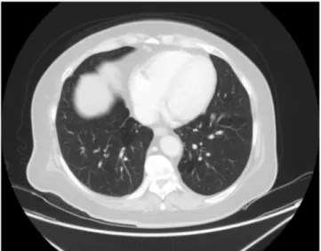 Fig. 2. After 10 months on control CT examination, bronchiectasis appearance could not be seen.