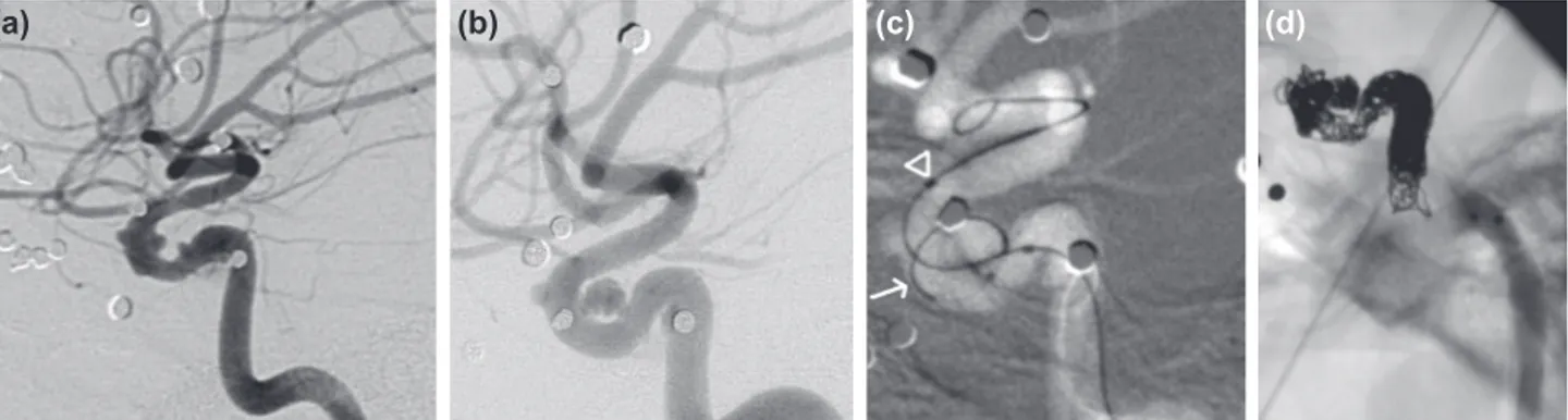 Figure 1. Case 2; (a) Magnified views of the right carotid angiogram in lateral projection obtained after the assault reveals three tiny ane-