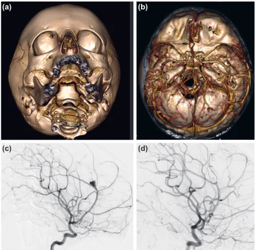 Figure 3. Case 5; (a) Base view obtained from 3D rendering of head CT reveals a focal bony 