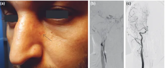 Figure 4. Case 6; (a) Photograph of patient 6 when he returned for a control angiogram 5 months after the injury and 4 