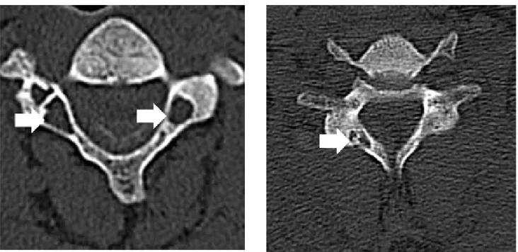 Figure 1. Axial cervical computed tomography scans showing the areas of osteolysis with peripheral sclerosis (a) in the C3 vertebral pedicles, and (b) C6 vertebral  right lamina (white arrows).