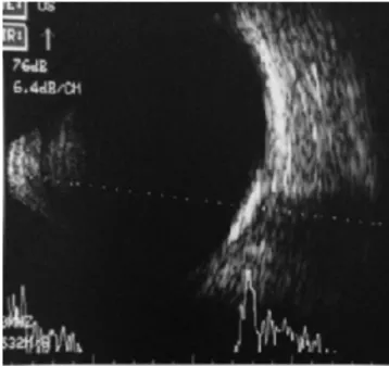 Figure 3. B-scan ultrasonography imaging of the right eye reveals a choroidal 