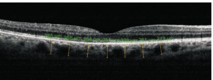 Figure 2 Choroidal thickness measurements of a patient with BRVO after intravitreal ranibizumab treatment.