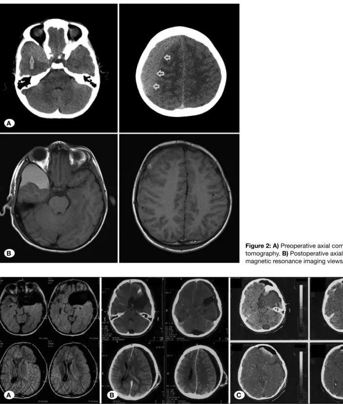 Figure 2: A) Preoperative axial computed  tomography. B) Postoperative axial T1W  magnetic resonance imaging views (case 4).