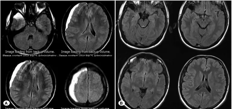 Figure 5: A) Preoperative axial CT scan of a 20-year-old patient with chronic subdural hematoma