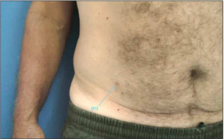 Figure 3: The lesion, composed of squamous epithelium presenting 