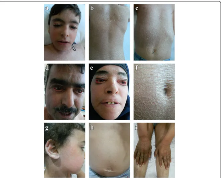 Fig. 2 Dermatological characterization of CDS patients. Lamellar ichthyosis affecting facial region (a, d, e, g), trunk (b, c, f, h), and extremities (i) of child (patient IV-1; a, b, c), father (patient III-2; d), mother (patient III-1; e, f) and cousin (