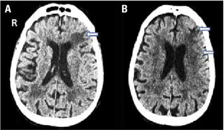 Figure 2. A photograph of the large hematoma after linear incision for  drainage