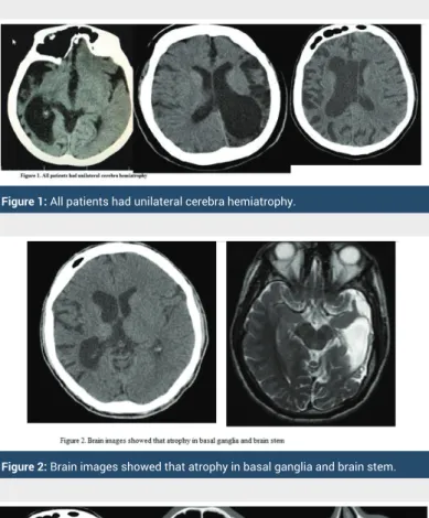 Figure 2: Brain images showed that atrophy in basal ganglia and brain stem.