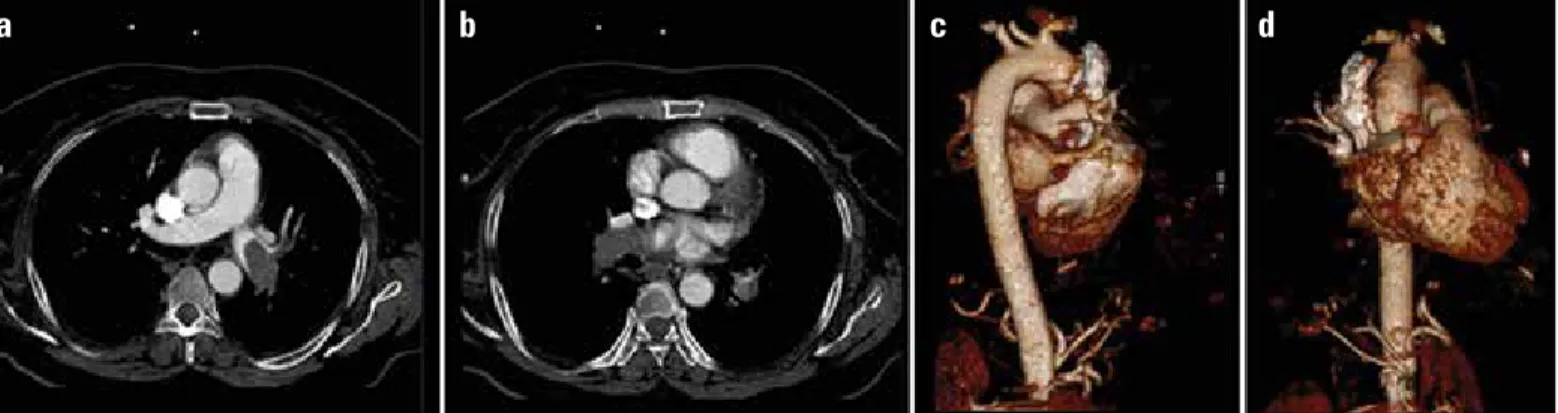 Figure 2. a, b. Brain diffusion MRI (b1000): demonstrated acute infarct  areas in the left occipital (a) and bilateral cerebellar lobes (b)