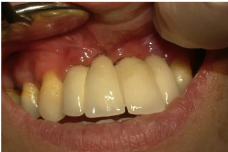 Fig. 3. Three months later from implant surgery, there were no radiographic com-