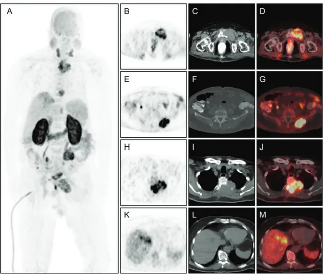 Figure 2. As an alternative PET/CT imaging,  68 Ga-prostate-specific membrane antigen (PSMA) PET/CT was performed the same day