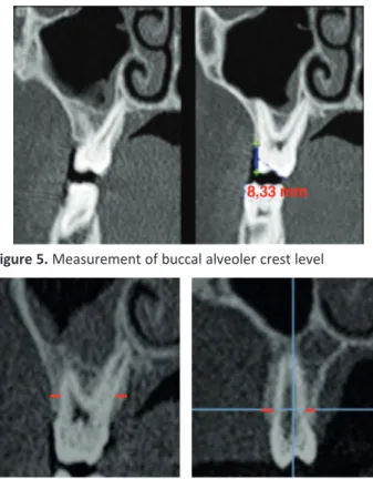 Figure  4.   Measurements  of  the  upper  buccal  bone  thickness 