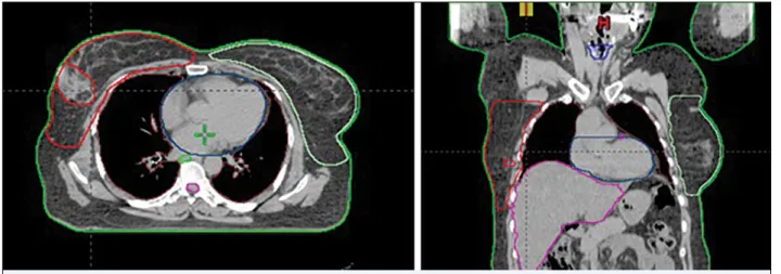 Fig. 1.  The breast contouring. (a) axial slide (b) koronal slide.