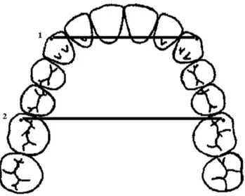 Figure 5.  Dental cast measurements used in the study. 1. Intercanine width,  2. Intermolar width.