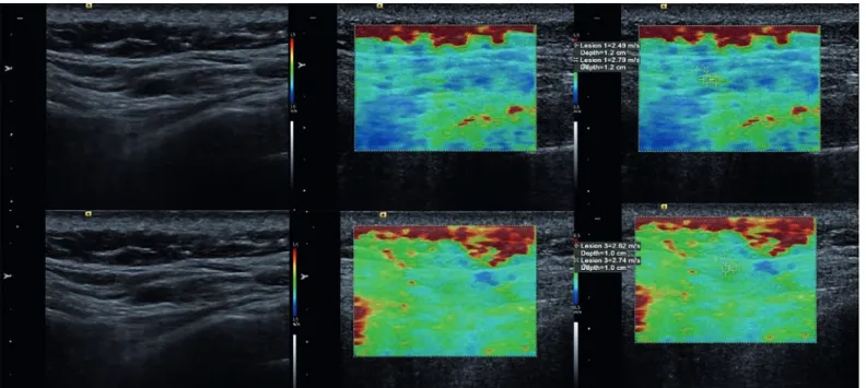 FIGURE 2. A 35-year-old man with active MTrP within the trapezius muscle. Upper row demonstrates pretreatment US and SWE images