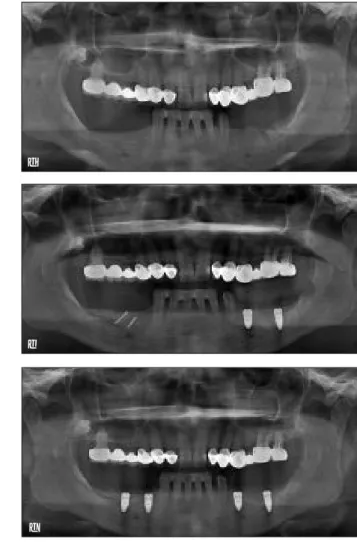 Fig 4    (a) Preoperative clinical image. (b) Postoperative clinical  image. (c) Image of augmented crest at time of implant  inser-tion
