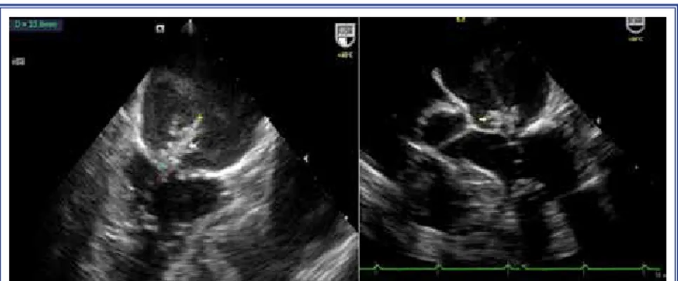 Figure 2.  Vegetation 23.8×13.0 mm in size on the mitral valve, 2- and 4-chamber  views.