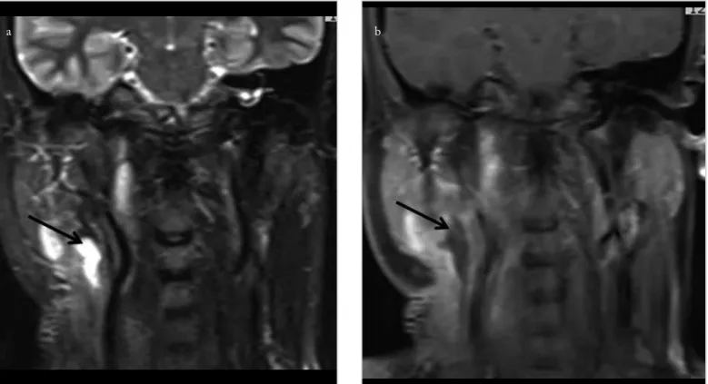 Figure 3. a, b. Postoperative fat-suppressed T2-weighted (a) and contrast-enhanced fat-suppressed T1-weighted (b) coronal MRI sections of  neck reveal reduction in necrosed and inflamed areas