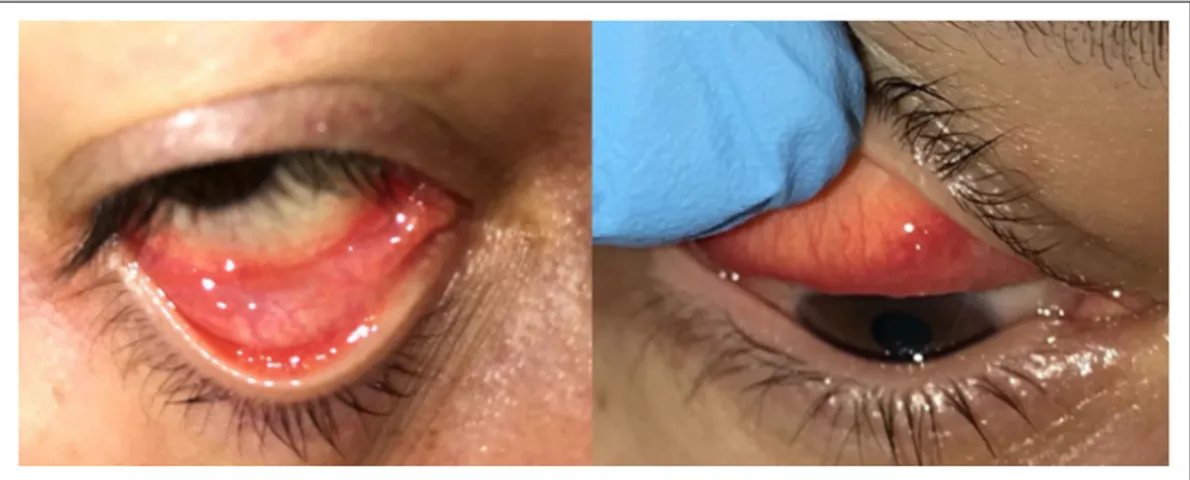 Figure 1.  A follicular conjunctival reaction in the upper and lower fornices, serous secretion, and mild chemosis in the right eye of  the patient two days before the diagnosis of COVID-19.