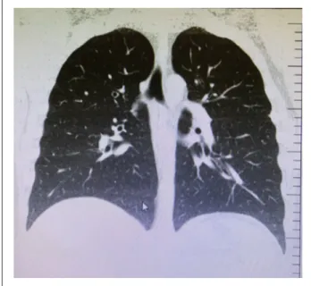 Figure 2.  Computed tomography of the pulmonary  parenchyma showing no sign of pneumonia.