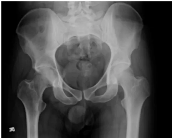 Figure 1. X-ray AP pelvis. Osteopenia beginning  from the trochanteric region and includes all of the  iliac wing on the right hip