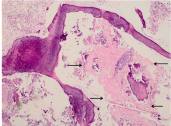 Figure 4. Ficat-Arlet grade 3 avascular necrosis on  the right hip.