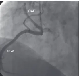 Fig. 3  Angiogram shows a coronary arteriovenous fistula (CAF) originating 