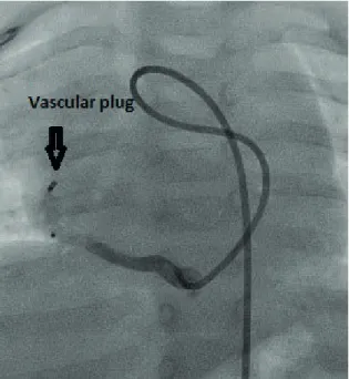 Fig. 2. In a 14.5 year-old patient, five platinum coils 