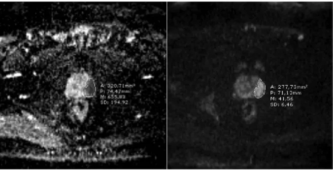 Figure 1. Axial apparent diffusion coefficient map of a corresponding patient demonstrating prostate tumor at left periheral zone