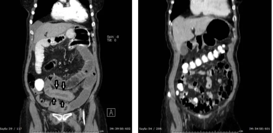 Figure  1.  Thickening  of  the  intestinal  wall  (ar- (ar-rows) was identified in the coronal CT images