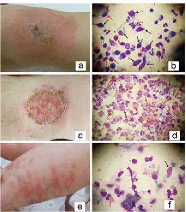 Figure 2. Clinical and cytologic findings of patients with  spongiotic dermatoses, 2a
