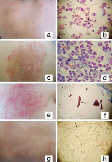 Figure 4. Clinical and cytologic findings of patients with  pemphigus and bullous pemphigoid, 4a