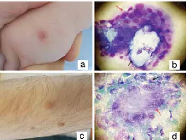 Figure 6. Clinical and cytologic findings of patients  with granulomatous eosinophilic dermatoses, 6a