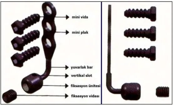 Şekil 3.1: Zigoma ankraj sistemi 
