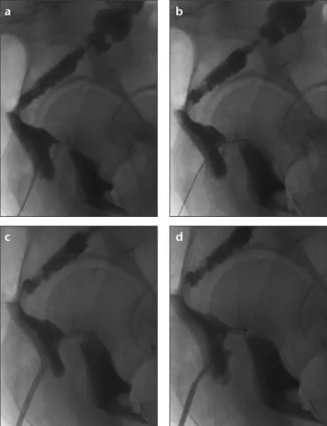 Figure 1. a–d. Lateral iodinated contrast study of the colon (a) 