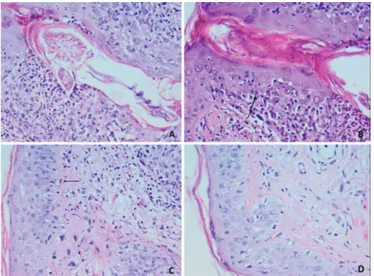 Figure  1.  A)  Demodex mite; B) Civatte body in the follicular  epithelium containing Demodexand lymphocyte exocytosis; C)  Civatte body in the epithelium far from the follicle; D) diffuse  basal vacuolization in epidermis (periodic acid-schiff staining, 