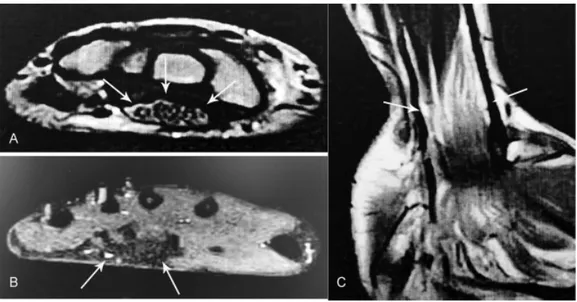 Fig. 1 Fibrolipomatous hamartoma of the median nerve. (A) Axial T1-weighted, (B) axial fat-suppressed T2-weighted, and (C) coronal T1- T1-weighted images show marked thickening of the median nerve with adipose tissue surrounding the nerve fascicles (arrows