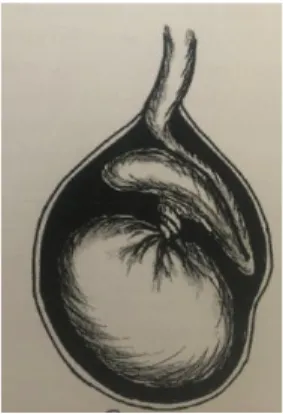 Şekil 2.8. Testisle epididim arasında oluşan intravaginal testis torsiyonu (37). 