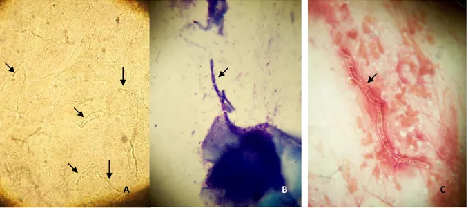 Şekil  2.8  Tinea  kapitisli  hastanın  püstüler  lezyonundan  alınan  yaymanın  mikroskopik 