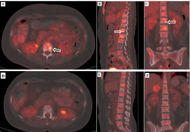 Şekil 1. SRC öncesi A) axial B) sagittal C) koronal PET-BT görüntüleri;  SRC  sonrası  3