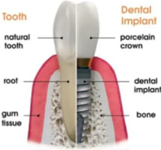 Figure  2.2 Dental Implant  Comparison with Natural  Teeth  [85] 