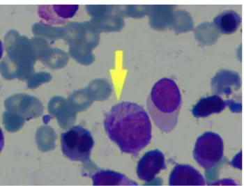 Fig. 1 Bone marrow smear is showing promyelocyte with Auer rods (Wright–Giemsa staining, 1009 magnification)
