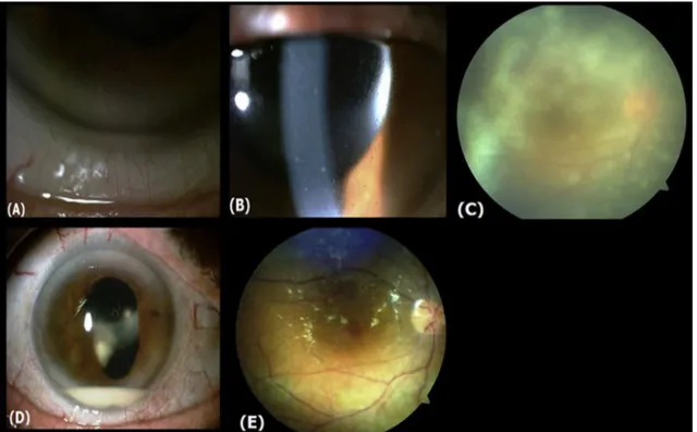 Fig. 1. (A) Anterior segment photograph of cornea, showing endothelial folds due to edema