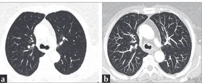 Figure 3. A 64-year-old female patient. Figure 3a shows a peripheral nodule in the right lung in axial 3 mm sections