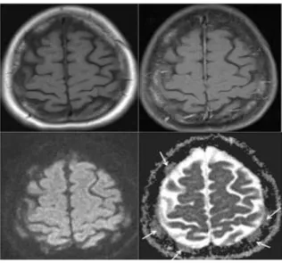Figure 1.a-d. A 56-year-old woman with breast cancer. Axial T2- weighted (a), T1- weighted (b), diffusion-weighted MR  images(c) and ADC map (d) show multiple cranial bone marrow metastases
